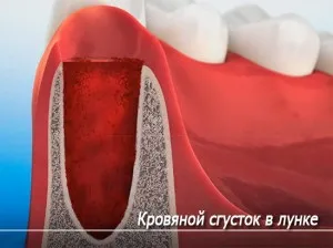 Після видалення зуба в лунці щось біле фото фібринозного нальоту на яснах (біле) Після видалення зуба в лунці щось біле фото фібринозного нальоту на яснах