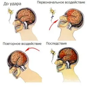 Наслідки струсу головного мозку як розпізнати і що робити (наслідки) Наслідки струсу головного мозку як розпізнати і що робити