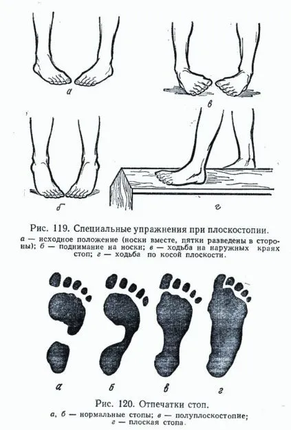 Поперечна плоскостопість - симптоми і лікування у дорослих, що це і причини появи фото (поперечна плоскостопість) Поперечна плоскостопість - симптоми і лікування у дорослих, що це і причини появи фото