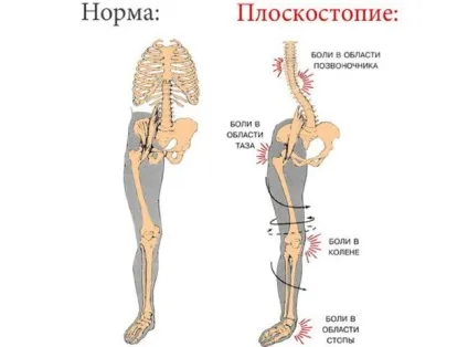 Поперечна плоскостопість - симптоми і лікування у дорослих, що це і причини появи фото (симптоми) Поперечна плоскостопість - симптоми і лікування у дорослих, що це і причини появи фото