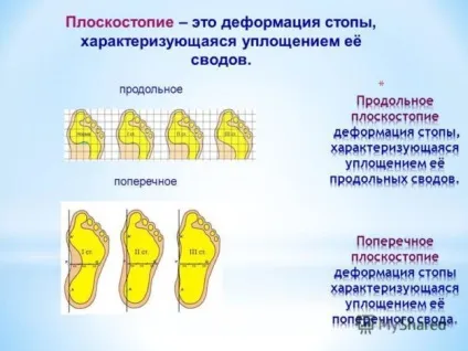 Поперечна плоскостопість - симптоми і лікування у дорослих, що це і причини появи фото (поперечна плоскостопість) Поперечна плоскостопість - симптоми і лікування у дорослих, що це і причини появи фото