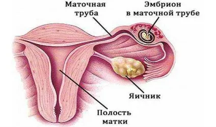 Як відрізнити місячні від кровотечі види, причини, тривалість, що робити при втраті крові (захворювання) Як відрізнити місячні від кровотечі види, причини, тривалість, що робити при втраті крові