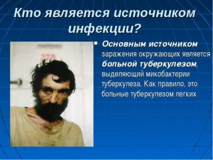 Як розпізнати туберкульоз симптоми і перші ознаки у дорослого на ранніх стадіях (туберкульоз) Як розпізнати туберкульоз симптоми і перші ознаки у дорослого на ранніх стадіях