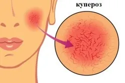 Препарати для лікування купероза на обличчі (лікування) Препарати для лікування купероза на обличчі