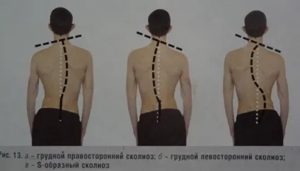 Правобічний сколіоз ЛФК, вправи, масаж (вправи) Правобічний сколіоз ЛФК, вправи, масаж