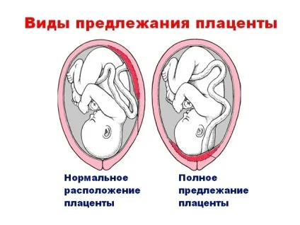Передлежання плаценти види і ступеня, причини, чим небезпечне, діагностика і лікування (причини) Передлежання плаценти види і ступеня, причини, чим небезпечне, діагностика і лікування