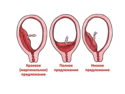 Передлежання плаценти види і ступеня, причини, чим небезпечне, діагностика і лікування (плаценти) Передлежання плаценти види і ступеня, причини, чим небезпечне, діагностика і лікування