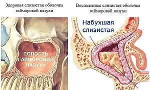 Катаральний гайморит види, симптоми і лікування, профілактика (катаральний) Катаральний гайморит види, симптоми і лікування, профілактика
