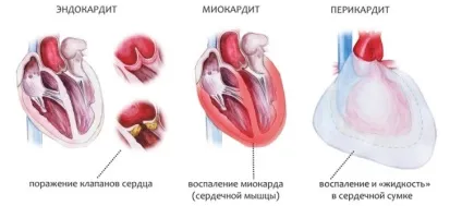 Кардит що це таке, чим небезпечне, симптоми і лікування