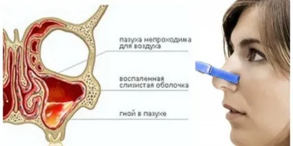 Катаральний гайморит види, симптоми і лікування, профілактика (симптоми) Катаральний гайморит види, симптоми і лікування, профілактика