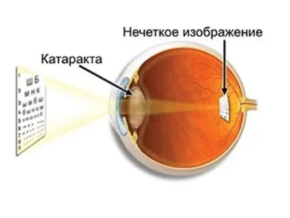 Катаракта лікування народними засобами відгуки, ефективність, без операції