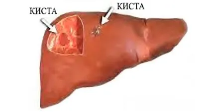 Кіста печінки причини, діагностика та методи лікування (печінки) Кіста печінки причини, діагностика та методи лікування