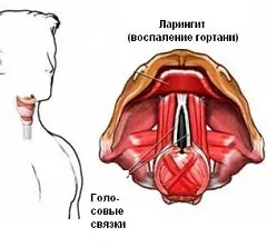 Ларингіт - симптоми, лікування, причини, види, допомога (ларингіт хронічний) Ларингіт - симптоми, лікування, причини, види, допомога