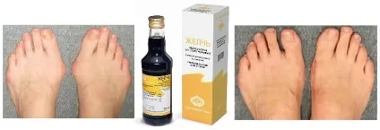 Лікування кісточок на ногах жовчю застосування медичної жовчі при кісточках на ногах