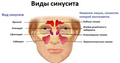 Лікування синуситу і затяжного нежиті ліками і народними засобами у дорослих і дітей, (лікування) Лікування синуситу і затяжного нежиті ліками і народними засобами у дорослих і дітей,