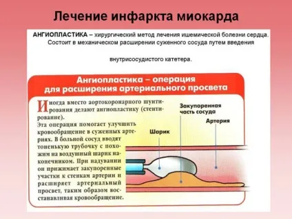 Лікування та реабілітація після інфаркту головного мозку - хірургічним шляхом, ішемічного, (інфаркту) Лікування та реабілітація після інфаркту головного мозку - хірургічним шляхом, ішемічного,
