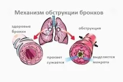 Ліки від обструктивного бронхіту (ліки) Ліки від обструктивного бронхіту