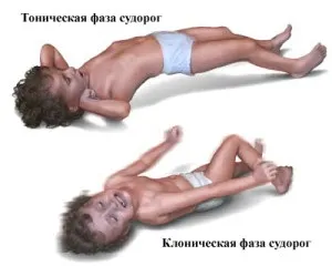Лівобічний геміпарез у дітей симптоми і лікування