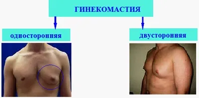 Ліпомастія (помилкова гінекомастія) у чоловіків - що це таке, лікування, як позбутися, фото до і після (таке) Ліпомастія (помилкова гінекомастія) у чоловіків - що це таке, лікування, як позбутися, фото до і після