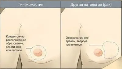 Ліпомастія (помилкова гінекомастія) у чоловіків - що це таке, лікування, як позбутися, фото до і після (помилкова) Ліпомастія (помилкова гінекомастія) у чоловіків - що це таке, лікування, як позбутися, фото до і після