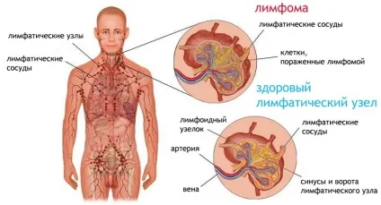Лімфома лімфома Ходжкіна і неходжскінскіе лімфоми, причини виникнення онкологічного (лімфома) Лімфома лімфома Ходжкіна і неходжскінскіе лімфоми, причини виникнення онкологічного
