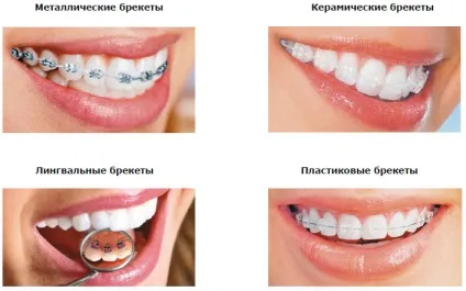 Лігатурні брекети і безлігатурні фото і види (брекети) Лігатурні брекети і безлігатурні фото і види