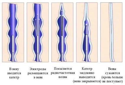 Лікування вен після операції - реабілітація та профілактика (після) Лікування вен після операції - реабілітація та профілактика