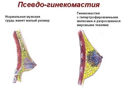 Хибна гінекомастія у чоловіків симптоми, лікування, видалення (чоловіки лікування помилкова гінекомастія справжня видалення відгук причина) Хибна гінекомастія у чоловіків симптоми, лікування, видалення