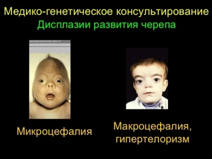 Макроцефалія (мегалоцефалія, метал оцефалія) причини, лікування (мікро і макроцефалія) Макроцефалія (мегалоцефалія, метал оцефалія) причини, лікування