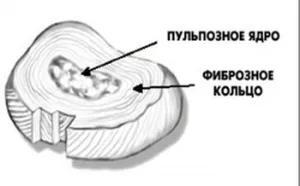 Медіанна протрузія диска
