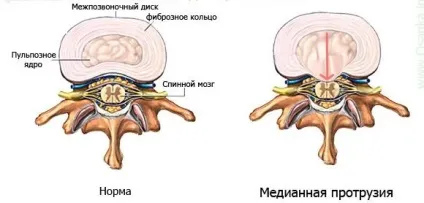 Медіанна протрузія диска