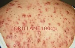 Прищі на спині і плечах причини, лікування, фото і відео поради (прищів спині плечах) Прищі на спині і плечах причини, лікування, фото і відео поради