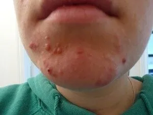 Прищі від солодкого на обличчі - чому з'являються (чому) Прищі від солодкого на обличчі - чому з'являються