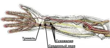 Причини і лікування оніміння пальців правої руки (лікування) Причини і лікування оніміння пальців правої руки