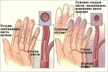 Причини і лікування оніміння пальців правої руки (причини) Причини і лікування оніміння пальців правої руки
