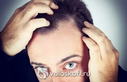 Причини лупи у чоловіків народні засоби, лікування (чоловіків) Причини лупи у чоловіків народні засоби, лікування