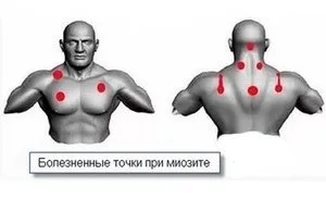 Міозит грудної клітини що це, його симптоми і лікування (симптоми) Міозит грудної клітини що це, його симптоми і лікування