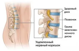 Методика лікування вправами доктора Бубновського грижі поперекового відділу