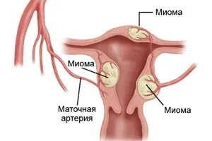 Міома тіла матки - лікування, симптоми, фото (міома) Міома тіла матки - лікування, симптоми, фото