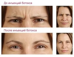 Зморшки між брів причини появи і способи позбавлення (способи) Зморшки між брів причини появи і способи позбавлення
