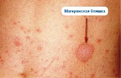Чи можна йодом мазати лишай у человка і як правильно (лишай) Чи можна йодом мазати лишай у человка і як правильно