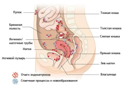 Мрт яєчників, матки і її шийки (яєчників) Мрт яєчників, матки і її шийки