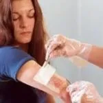 Народні засоби від опіку шкіри (опіку) Народні засоби від опіку шкіри