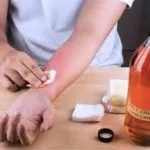 Народні засоби від опіку шкіри (засоби) Народні засоби від опіку шкіри