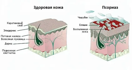 Негормональні креми від псоріазу (креми) Негормональні креми від псоріазу