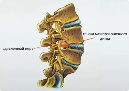 Німіє п'ята лівої, правої ноги причини, що робити (лівої) Німіє п'ята лівої, правої ноги причини, що робити