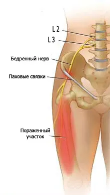 Невралгія стегнового нерва симптоми і лікування (нерва) Невралгія стегнового нерва симптоми і лікування