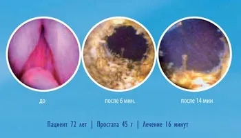 Новий погляд на альфа-блокатори при лікуванні простатиту (лікуванні) Новий погляд на альфа-блокатори при лікуванні простатиту