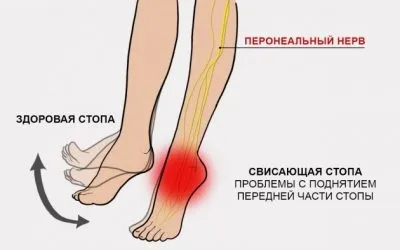 Нейропатія малогомілкового (великогомілкової) нерва симптоми і лікування (малоберцового) Нейропатія малогомілкового (великогомілкової) нерва симптоми і лікування