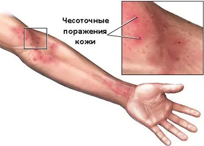 Норвезька короста що таке, симптоми і лікування хвороби (норвезька) Норвезька короста що таке, симптоми і лікування хвороби